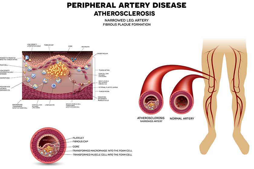 leg artery disease atherosclerosis